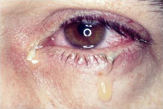 Detall d'un ull afectat per conjuntivitis vírica 