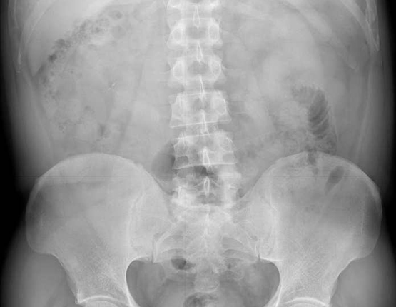 Una radiografia d'abdomen
