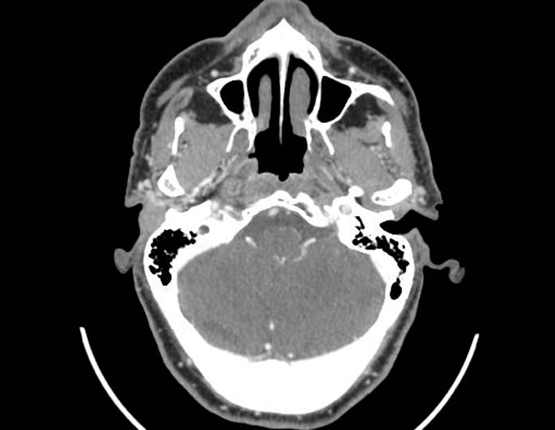 Una Tomografia Computada Crani