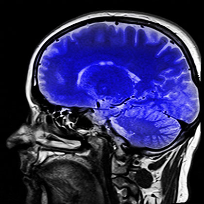 Una radiografia del cap, amb el cervell destacat en color lila