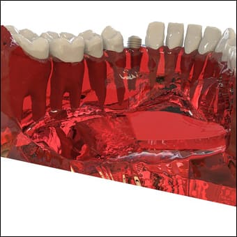 Simulació d'una boca amb implants