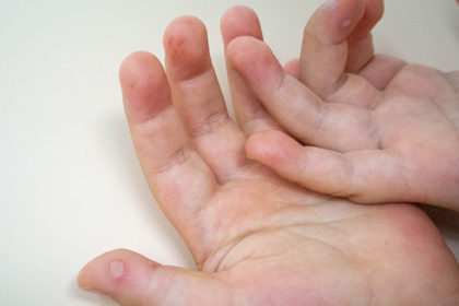 Les mans d'un infant amb l'erupció al palmell de les mans que pot provocar la malaltia.