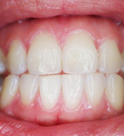 Primer pla de la boca d'una persona amb fricció de les dents superiors i inferiors