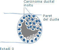 carcinoma_in_situ