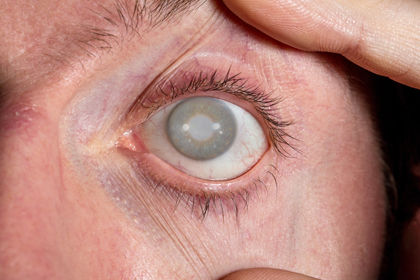 Un ull amb cataractes