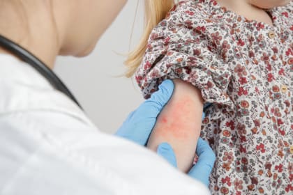 Una metgessa d'esquenes observa el braç d'una nena amb dermatitis atòpica