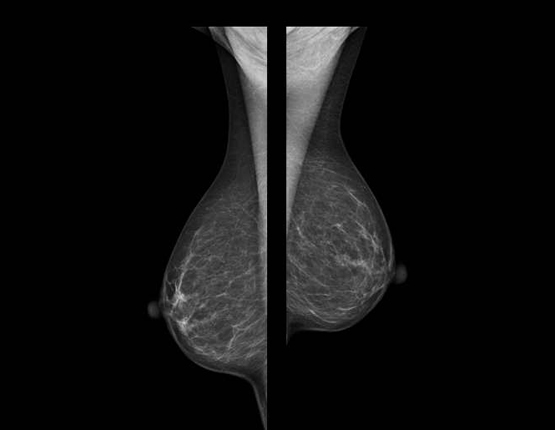 Una mamografia