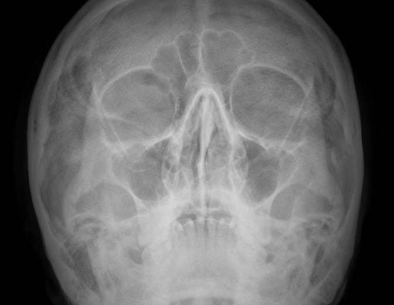 Una radiografia de crani