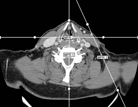 Una Tomografia Computada Cervical