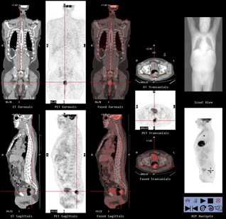 Tomografia per emissió de positrons (PET)