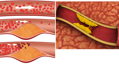 Procés d'evolució de l'obstrucció de l'artèria en cas de hipercolesterolèmia