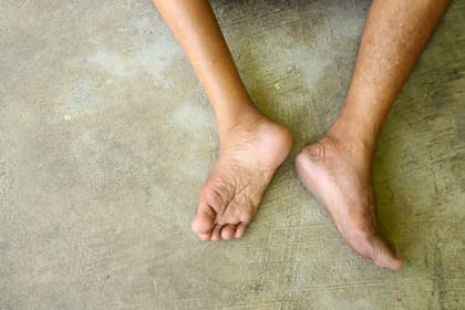 Les cames d'una persona afectada per la malaltia