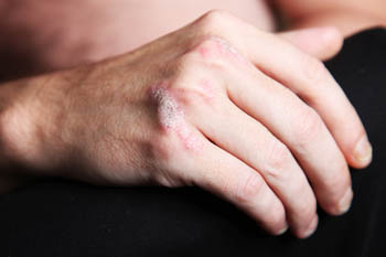La mà d'un home amb psoriasi