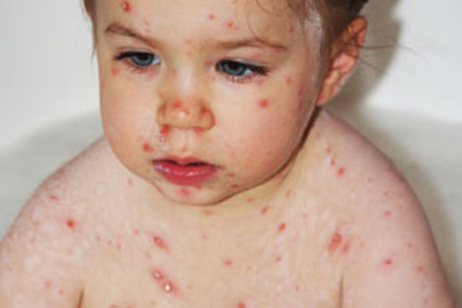 Una nena dins la banyera amb l'erupció a la pell característica de la varicel·la