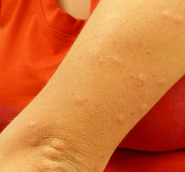 Pla detall del braç d'una persona amb picades de mosquit