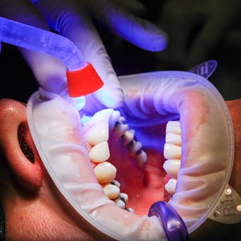 Una persona en ple procés d'emblanquiment dental